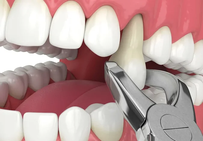 When Should I Consider Tooth Extraction?